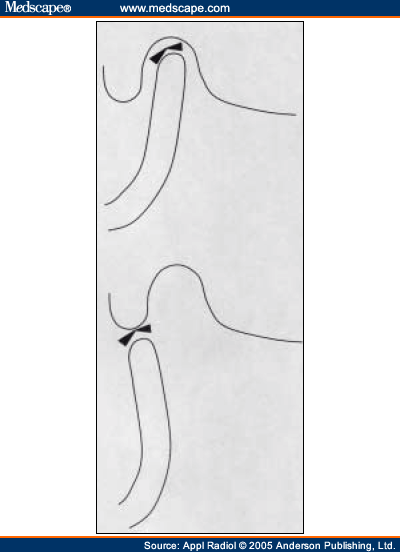Drawing of TMJ