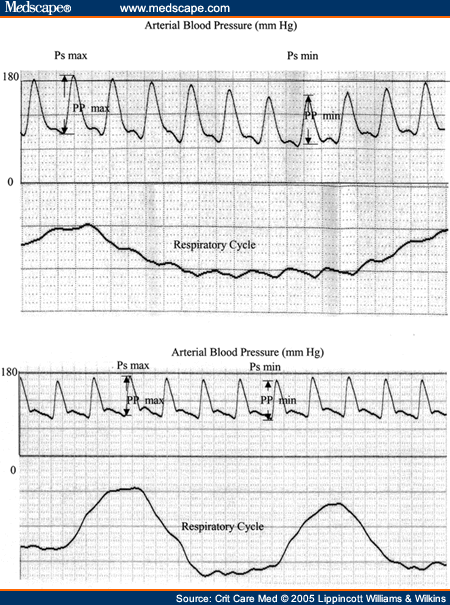 Pulse Pressure Variation