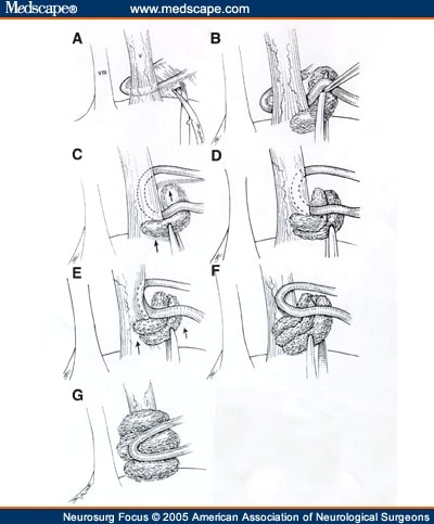 microvascular decompression doodle