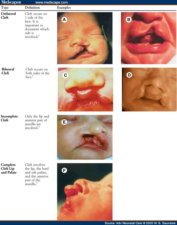 (A) Infant with unilateral cleft lip. Note the notch in the upper lip; 