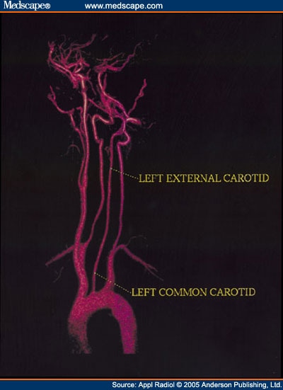internal carotid artery.