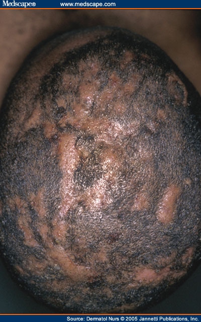Dissecting Cellulitis of the Scalp