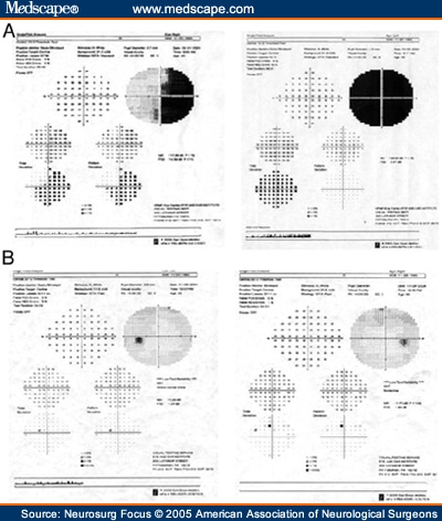 Visual Field Deficits