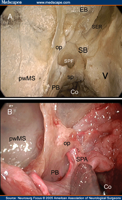 Sphenopalatine Fossa