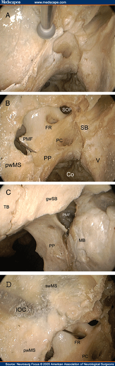 pterygopalatine foramen