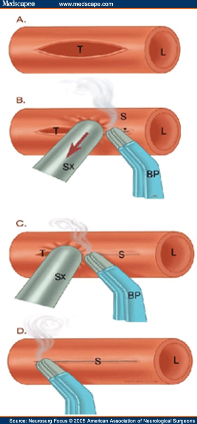 bipolar electrocautery