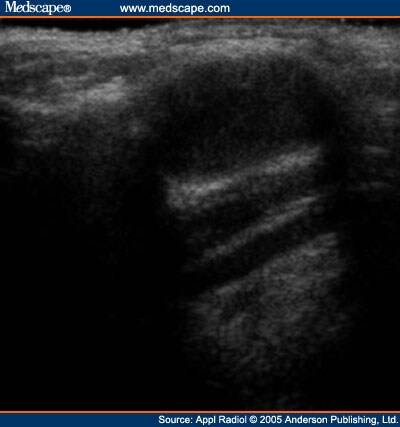 Thyroglossal duct cyst.