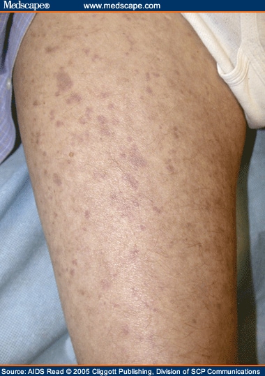 Vasculitis And Penumonitis In A Person With Hiv Infection