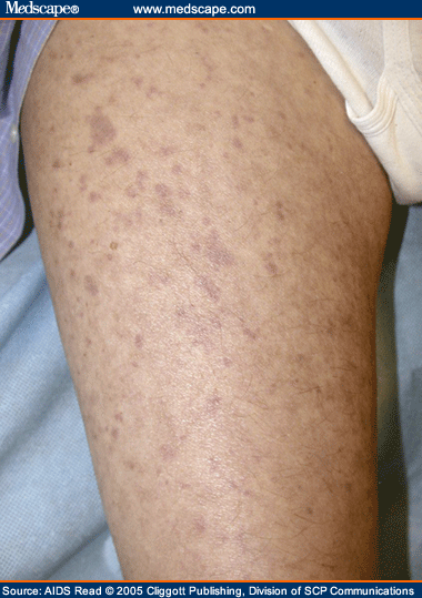 Erythematous purpuric macules