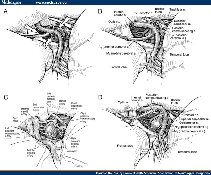 Skull Base Approaches To The Basilar Artery