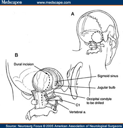 Suboccipital Craniotomy