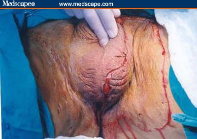 scrotal lesions