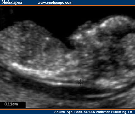 fetus at 12 weeks. measurement at 12 weeks 6