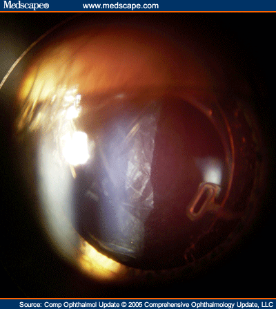  posterior vitreous detachment