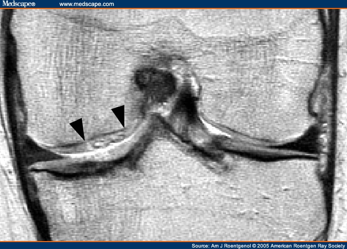 femoral condyle lesion