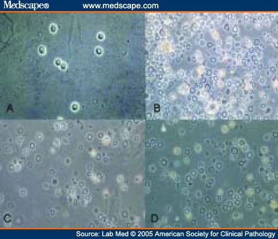 glomerular non hematuria haematuria sediment urine preservation