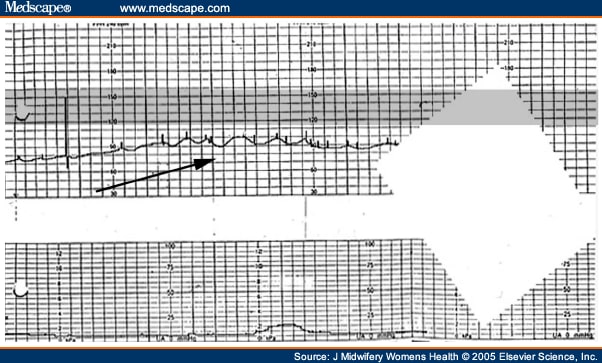 Sinusoidal Fetal Heart