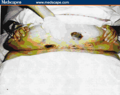 Meconium Stained Liquor