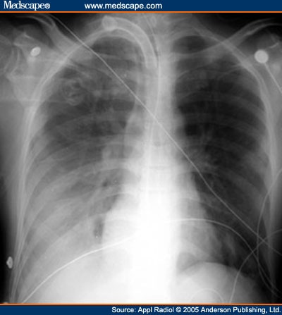 Lung Abscess Cxr