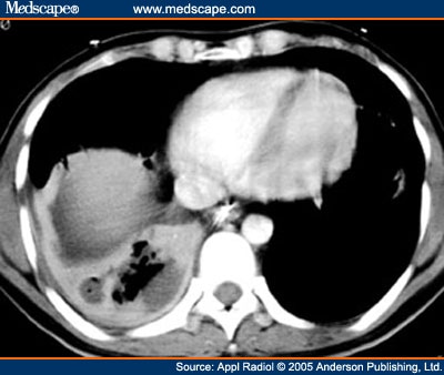 Chest Abscess