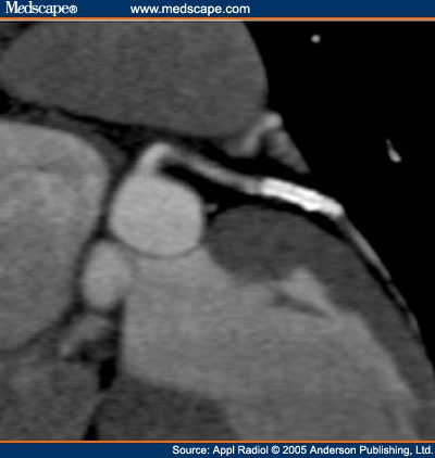 Atelectasis Vs Pneumonia