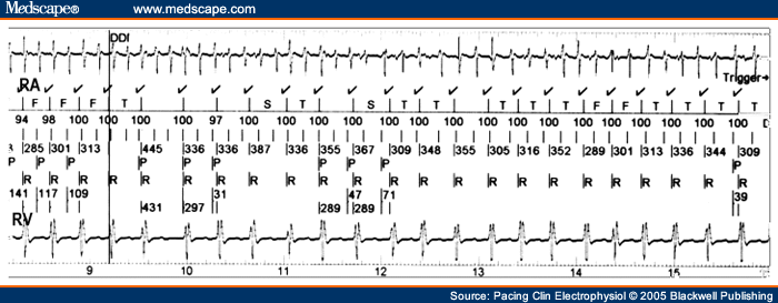 unspecified atrial fibrillation icd 10