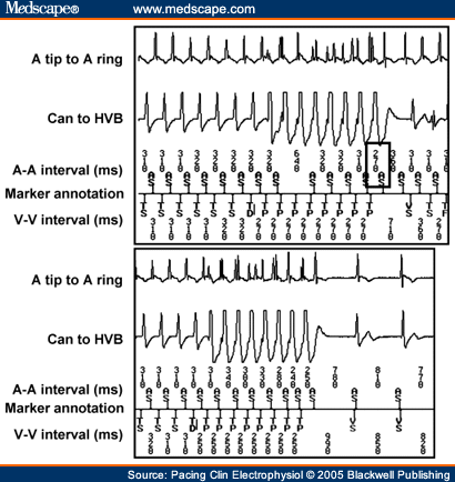 Vt Vs Svt