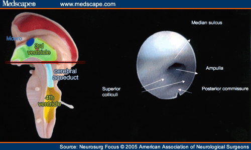 cerebral aqueduct anatomy