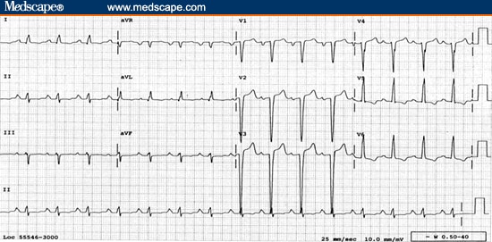 Anteroseptal Infarction