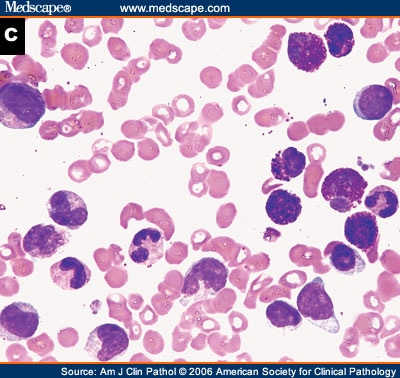 Cml Leukemia: ajcp521367 fig1c