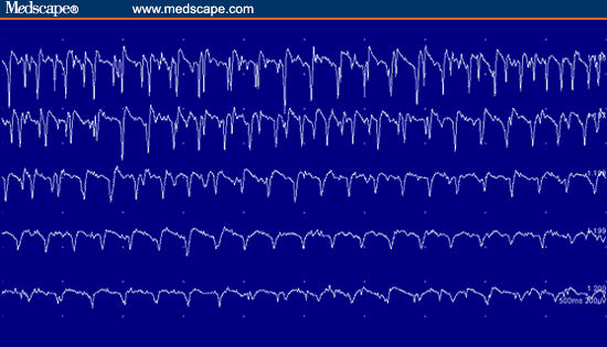 als emg findings als emg findings