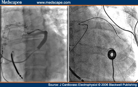 LV Lead Placement Within a Coronary Sinus Side Branch