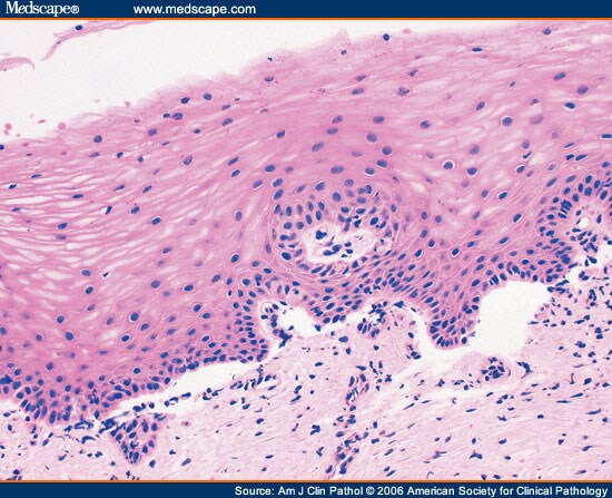 endo biopsy positive for inflammation