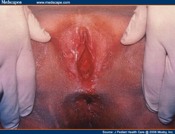 Early genital herpes lesions.