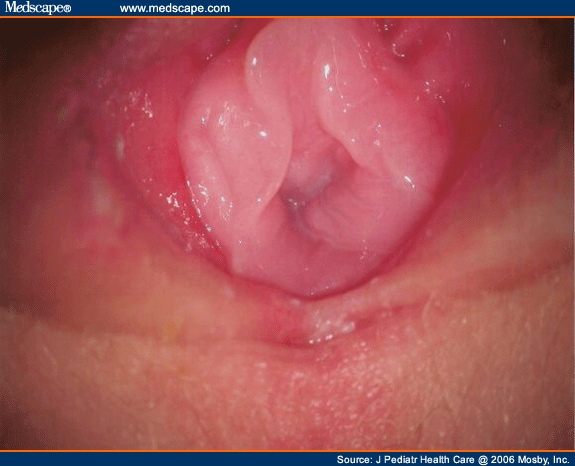 Normal hymen and posterior fourchette despite the presence of genital herpes 