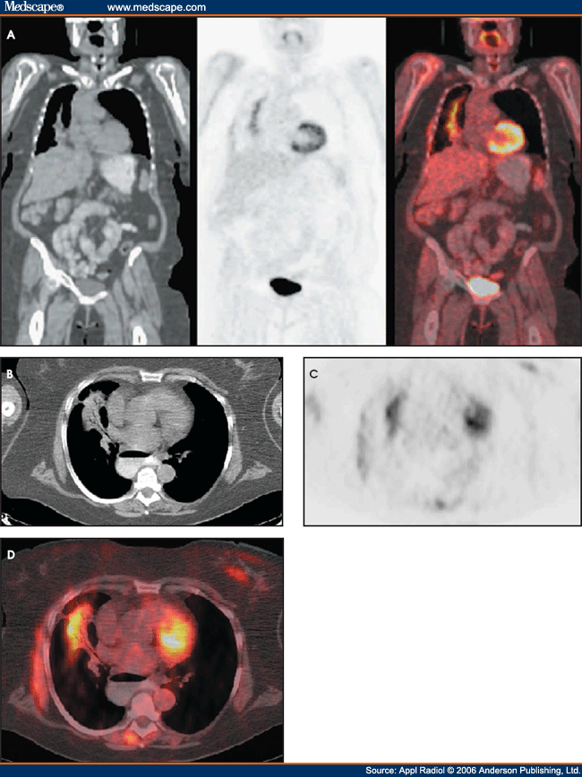 Right Middle Lobectomy