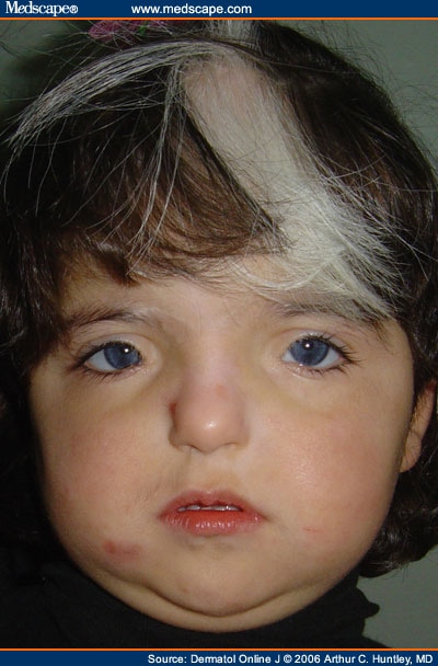 Waardenburg Syndrome Type 1: Clinical Synopsis