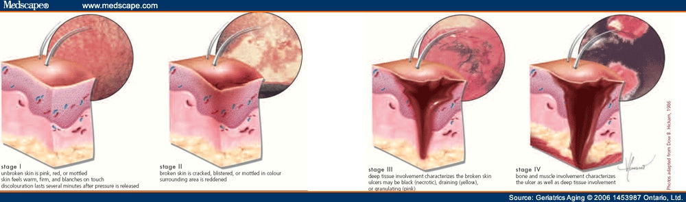 Dressings For Pressure Sores. Stages of Pressure Sores