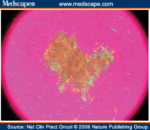 gout negative birefringence