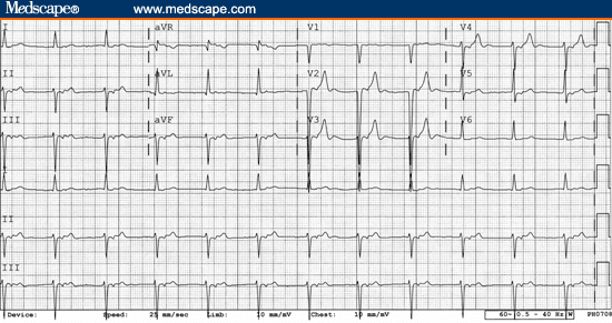  Accelerated idioventricular rhythm with 1:1 retrograde conduction to 
