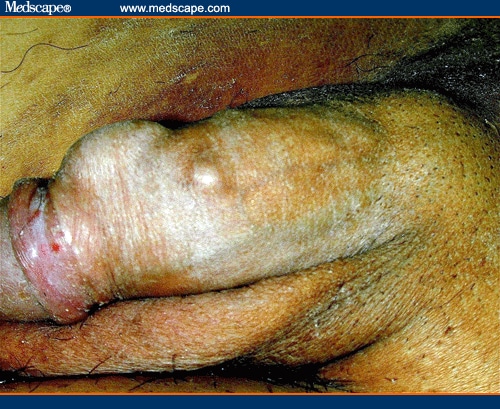 Tumor In Penis 16