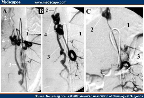 A: Contrast-enhanced segmental T-10 artery coursing from the left.