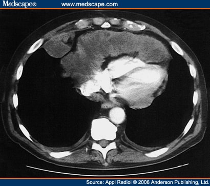 Cardiophrenic Recess