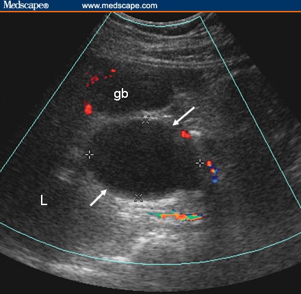 common bile duct ultrasound. hepatis common bile duct