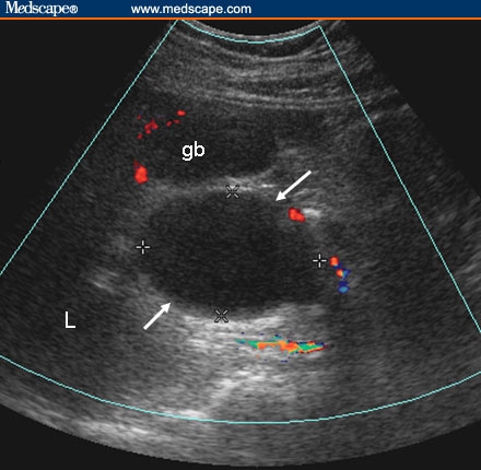 common bile duct obstruction. common bile duct cat,