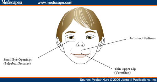 fetal alcohol syndrome. Images • Fetal growth