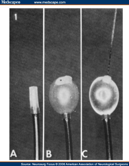 catheter occlusion