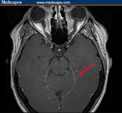 Bells Palsy on Woman With Bilateral Bell S Palsy  Hospital Course