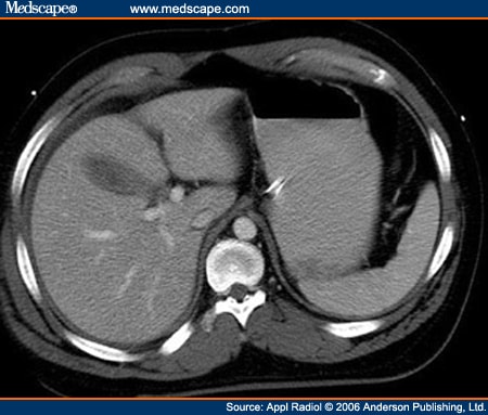 ruptured gall bladder