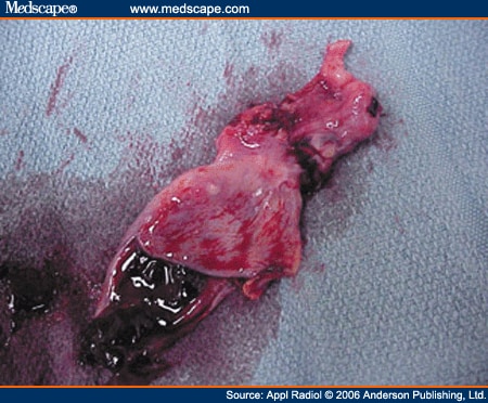 ruptured gall bladder